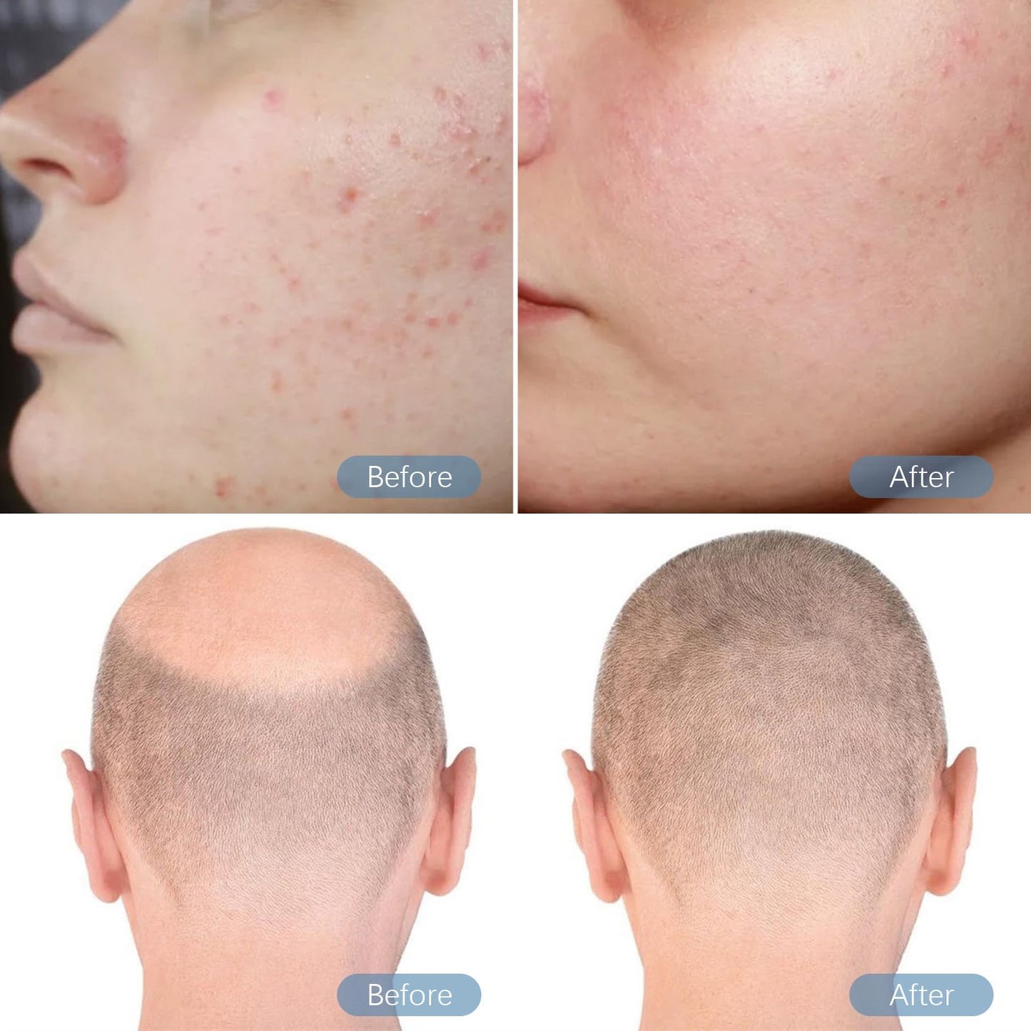 Dr. Pen M8S Microneedling Derma Pen with 2PCS Cartridges